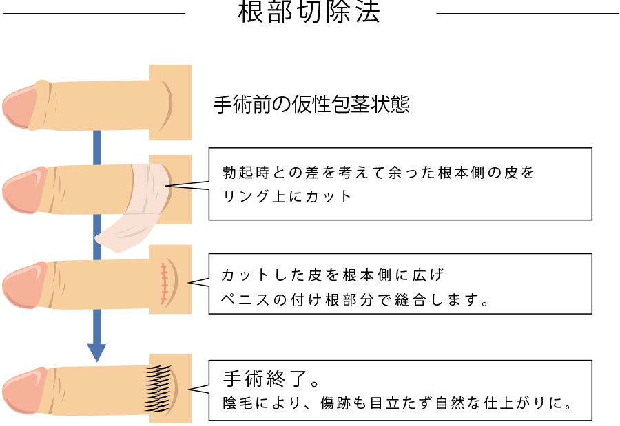 真性包茎とは｜上野クリニック