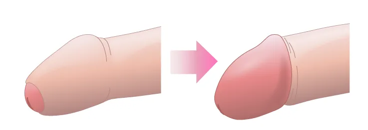 カントン包茎（嵌頓包茎）とは？手術と費用について｜MSクリニック