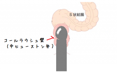 究極の性感帯、S字結腸の解説 - アナラーズディライト