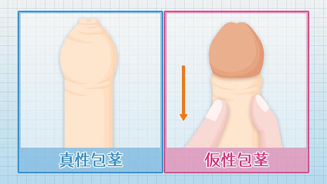 包茎とは・包茎の種類・包茎は病気なの？ – メンズ形成外科