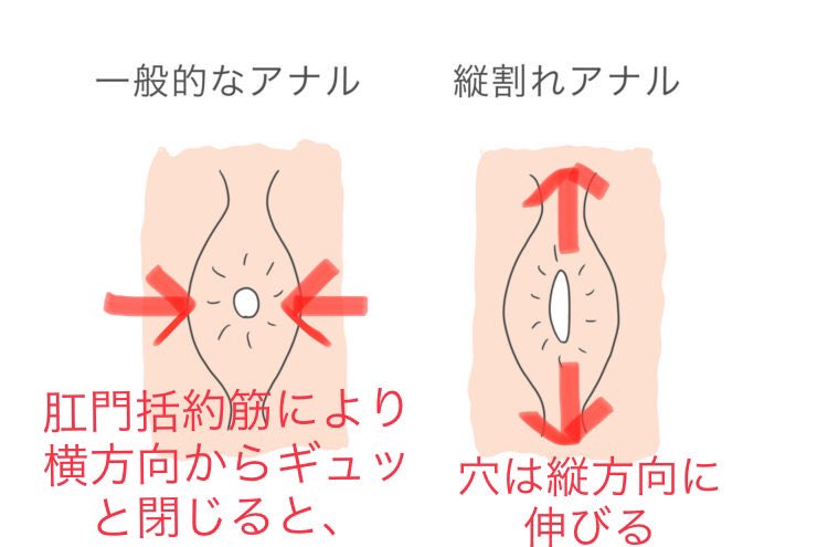 この〇ば ア〇ア様 スカトロ ぽっかり縦割れアナル 便失禁(anamonのフェチイラスト)