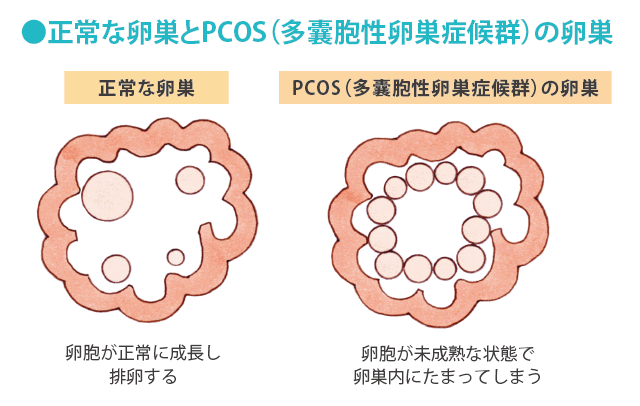 肥満の男性は体重減少で精子の数を2倍に増やせる 糖尿病の治療薬で肥満症を治療 | ニュース |