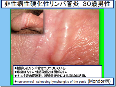 Ｇ責めカリキャップ （シングル） 格安通販 即日