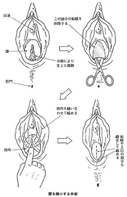 膣鏡 膣拡張 膣内観察大人のおもちゃ